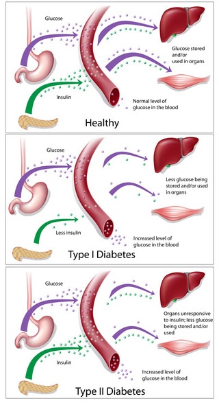 diabetes chart: type 1 and type 2 diabetes